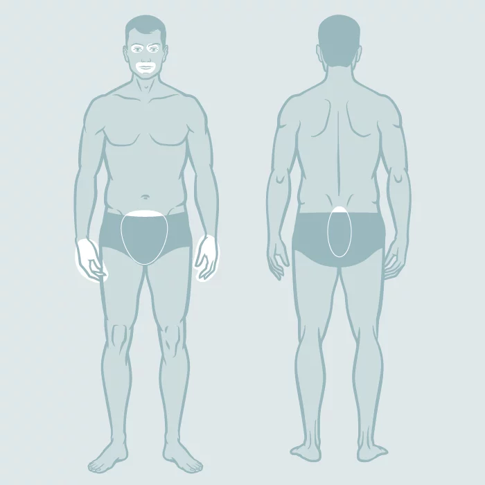 Weissfleckenkrankheit (Vitiligo)